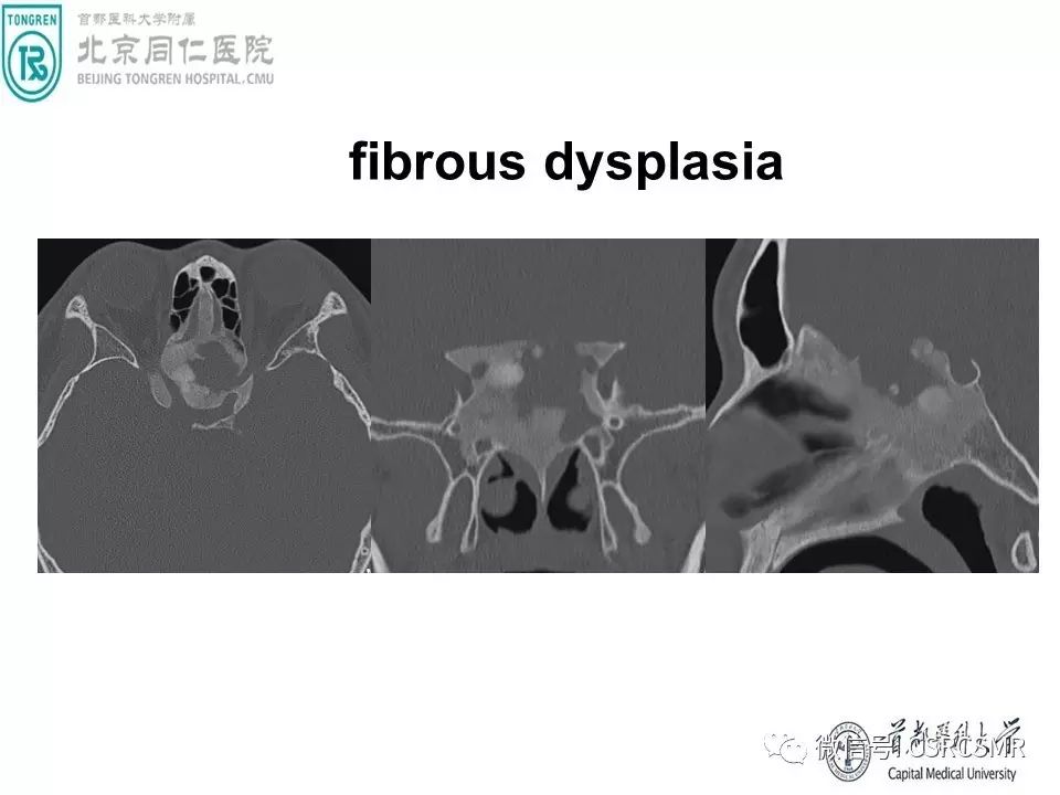【PPT】颅底骨源性肿瘤影像学分析思路