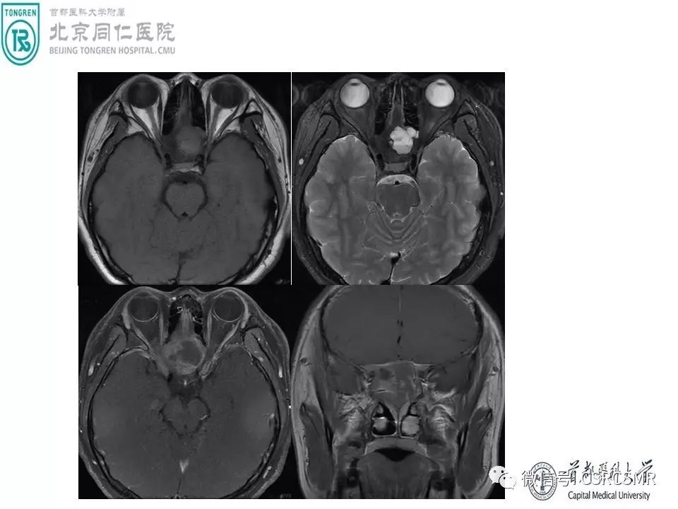 【PPT】颅底骨源性肿瘤影像学分析思路
