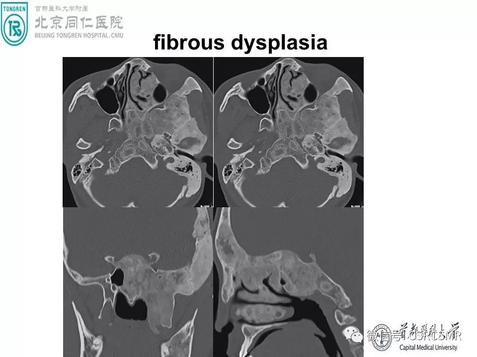 【PPT】颅底骨源性肿瘤影像学分析思路