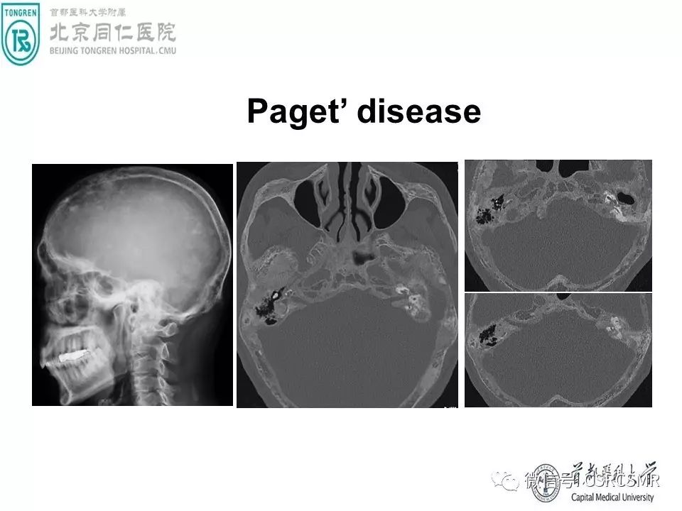 【PPT】颅底骨源性肿瘤影像学分析思路