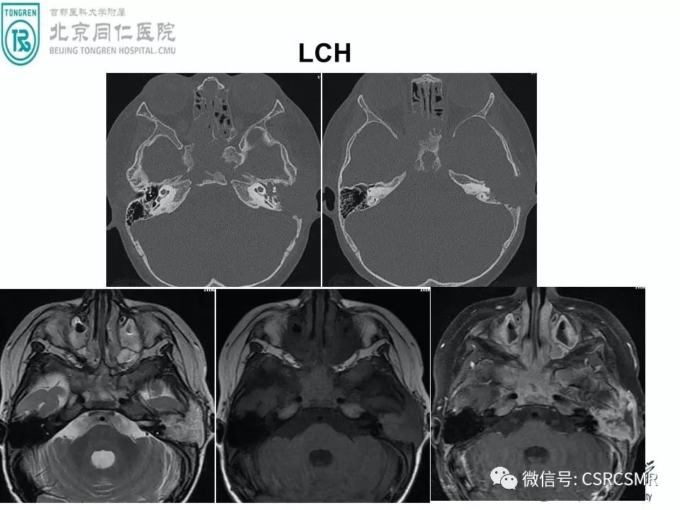 【PPT】颅底骨源性肿瘤影像学分析思路