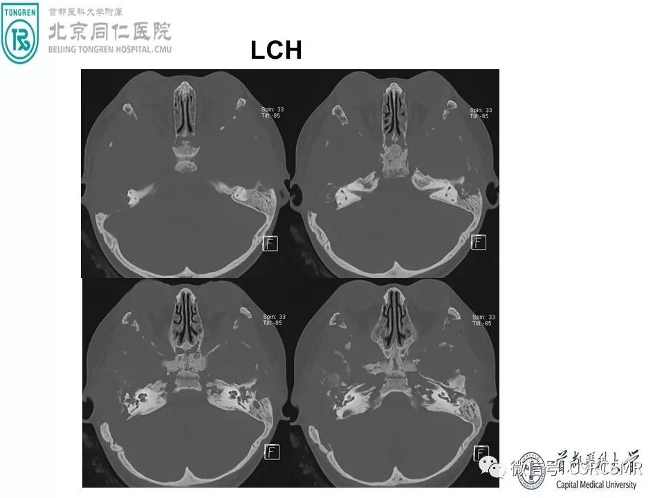 【PPT】颅底骨源性肿瘤影像学分析思路