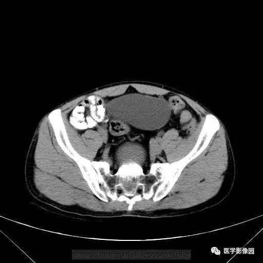 【病例】骶前支气管源性囊肿1例CT 【病例】骶前支气管源性囊肿1例CT