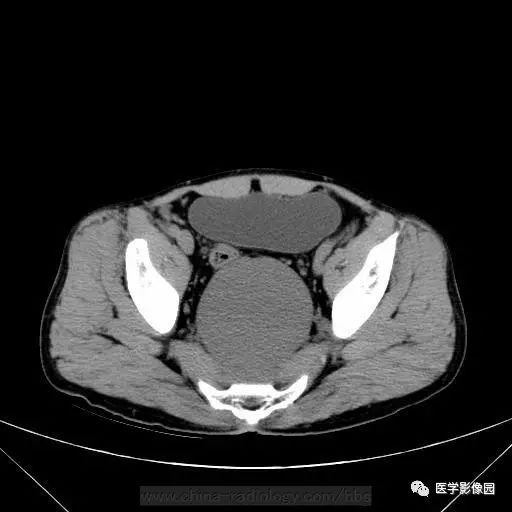 【病例】骶前支气管源性囊肿1例CT 【病例】骶前支气管源性囊肿1例CT