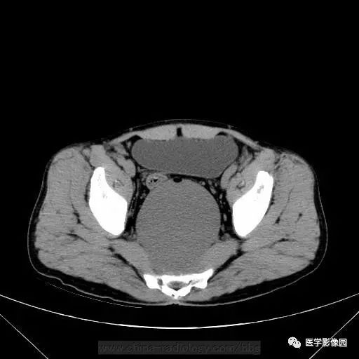 【病例】骶前支气管源性囊肿1例CT 【病例】骶前支气管源性囊肿1例CT