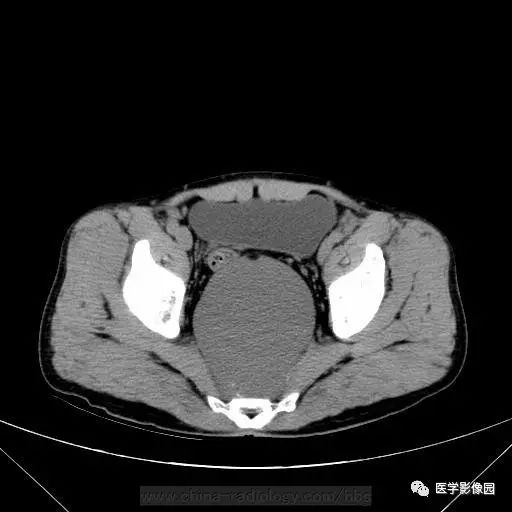 【病例】骶前支气管源性囊肿1例CT 【病例】骶前支气管源性囊肿1例CT