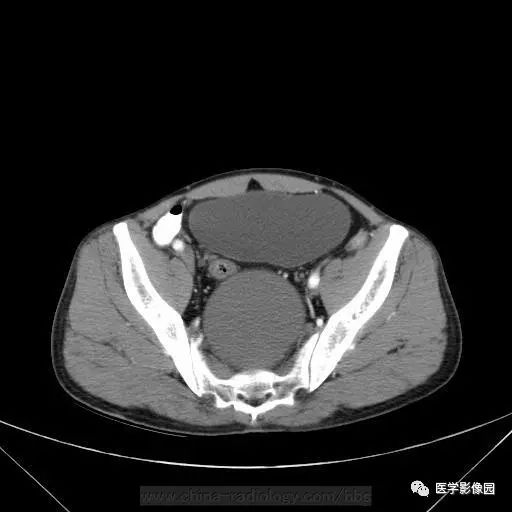 【病例】骶前支气管源性囊肿1例CT 【病例】骶前支气管源性囊肿1例CT