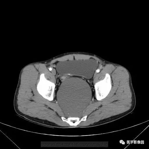 【病例】骶前支气管源性囊肿1例CT 【病例】骶前支气管源性囊肿1例CT