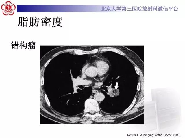 【PPT】(肺)结节(影像诊断)