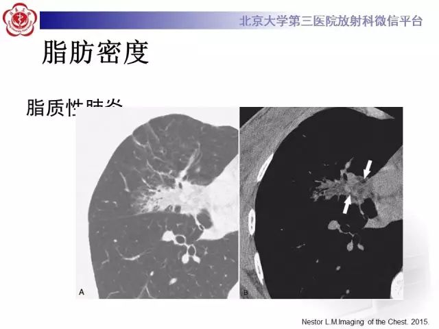 【PPT】(肺)结节(影像诊断)