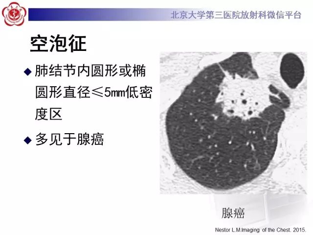 【PPT】(肺)结节(影像诊断)