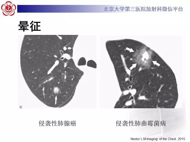 【PPT】(肺)结节(影像诊断)