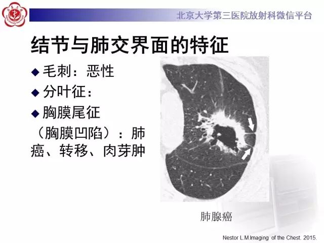 【PPT】(肺)结节(影像诊断)