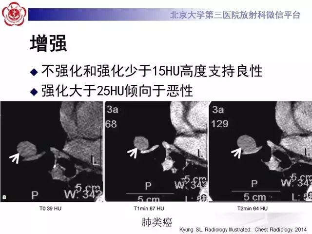 【PPT】(肺)结节(影像诊断)