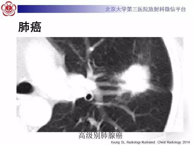 【PPT】(肺)结节(影像诊断)