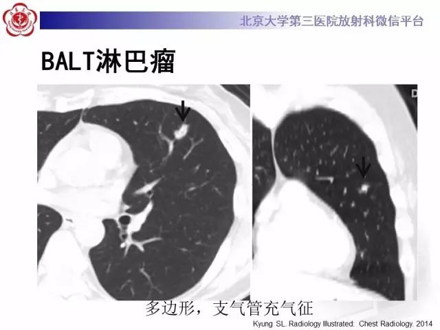 【PPT】(肺)结节(影像诊断)