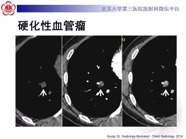 【PPT】(肺)结节(影像诊断)