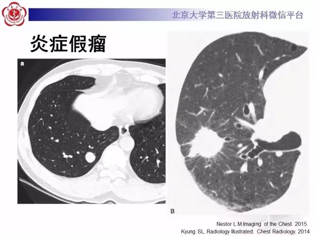 【PPT】(肺)结节(影像诊断)