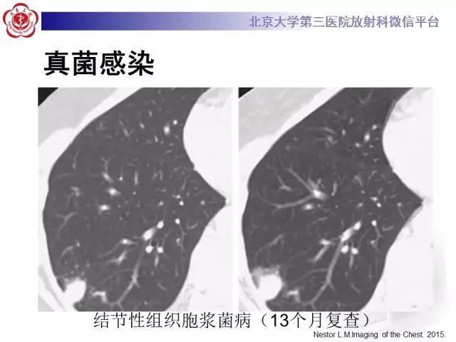 【PPT】(肺)结节(影像诊断)