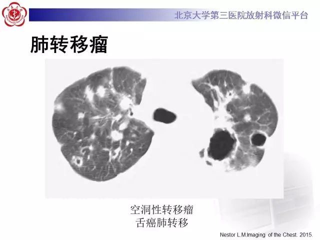 【PPT】(肺)结节(影像诊断)