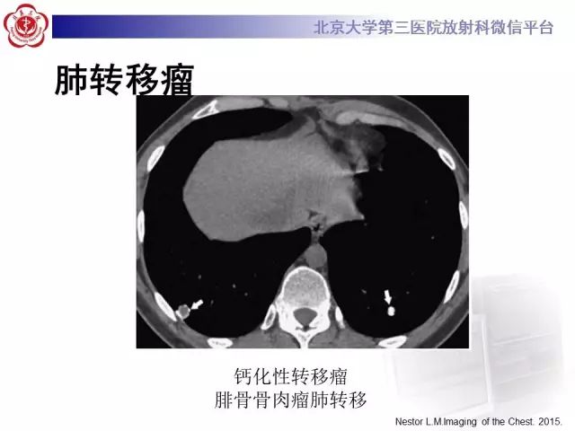 【PPT】(肺)结节(影像诊断)