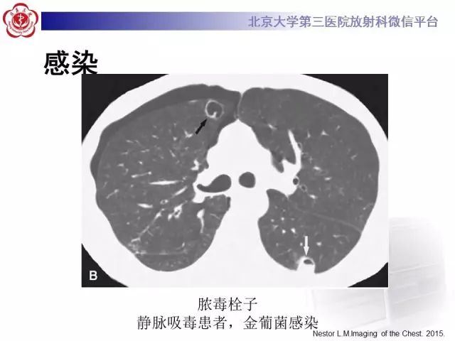【PPT】(肺)结节(影像诊断)