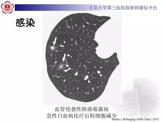 【PPT】(肺)结节(影像诊断)