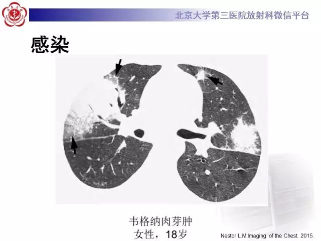 【PPT】(肺)结节(影像诊断)