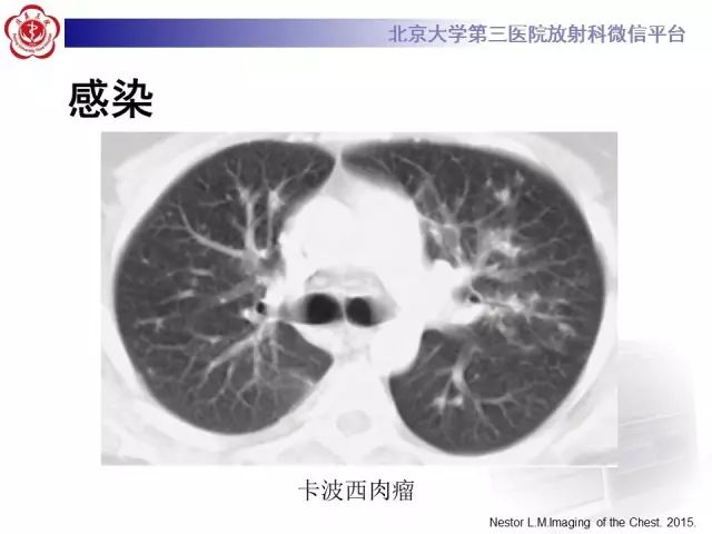 【PPT】(肺)结节(影像诊断)