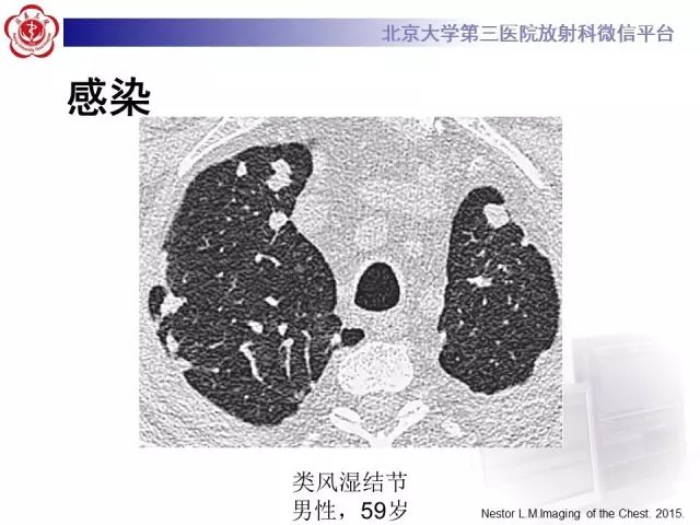 【PPT】(肺)结节(影像诊断)