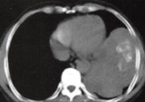 【病例】胸膜孤立性纤维瘤1例 【病例】胸膜孤立性纤维瘤1例