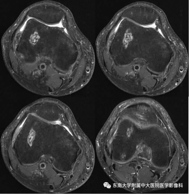 【病例】股骨股梗死1例MR影像表现