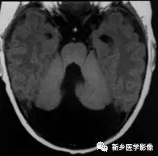 后颅窝积液的3种常见病变 后颅窝积液的3种常见病变