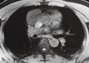 【病例】心包囊肿1例CT 【病例】心包囊肿1例CT