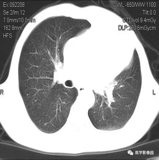 【病例】肺内占位?纵隔内占位? 【病例】肺内占位?纵隔内占位?