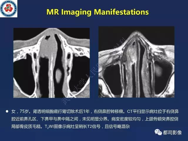 【PPT】鼻腔鼻窦转移瘤1例影像诊断