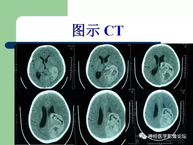 【病例】弥漫性星形细胞瘤1例CT及MR