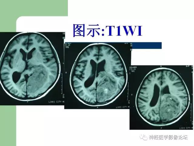【病例】弥漫性星形细胞瘤1例CT及MR