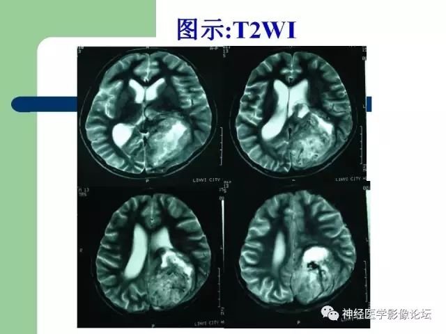 【病例】弥漫性星形细胞瘤1例CT及MR