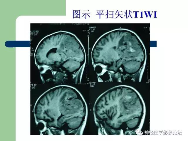 【病例】弥漫性星形细胞瘤1例CT及MR