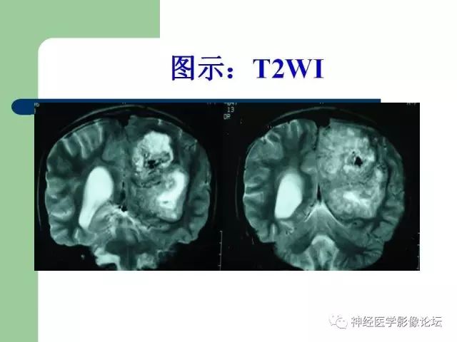 【病例】弥漫性星形细胞瘤1例CT及MR
