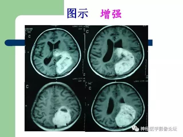 【病例】弥漫性星形细胞瘤1例CT及MR
