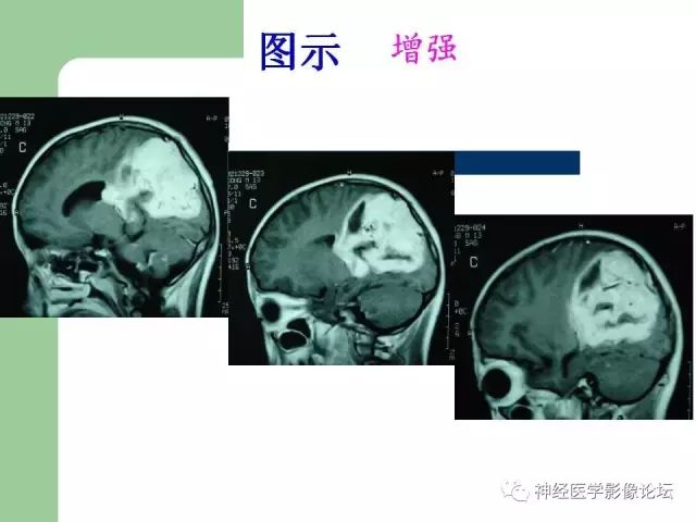 【病例】弥漫性星形细胞瘤1例CT及MR