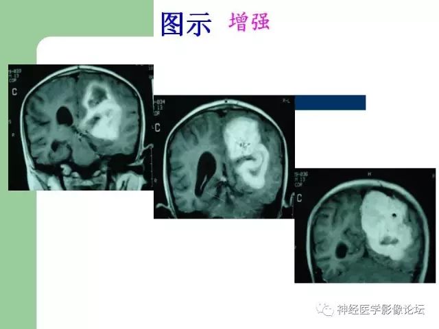 【病例】弥漫性星形细胞瘤1例CT及MR