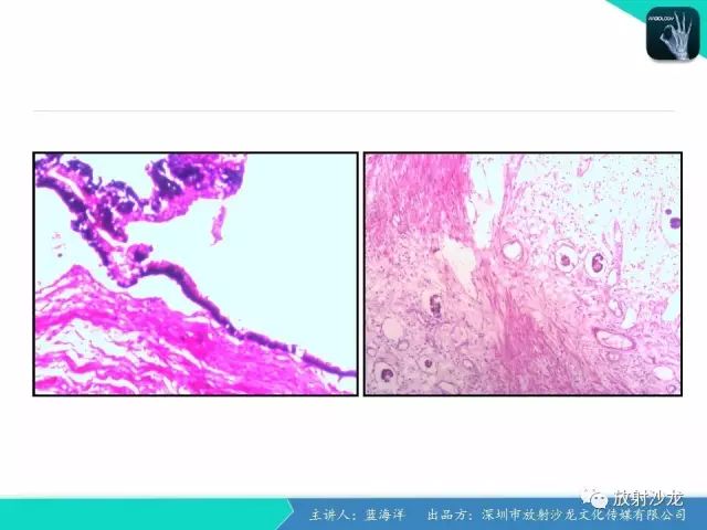 【病例】肠囊肿型重复畸形1例CT