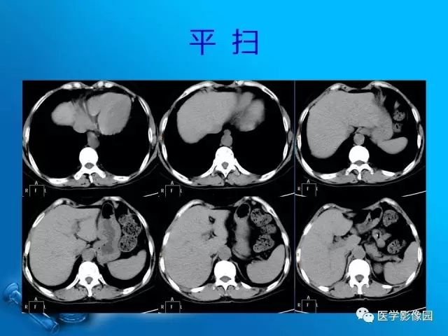 【病例】胆囊癌1例CT影像表现 【病例】胆囊癌1例CT影像表现