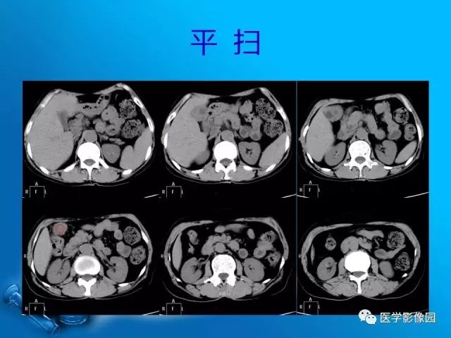 【病例】胆囊癌1例CT影像表现 【病例】胆囊癌1例CT影像表现