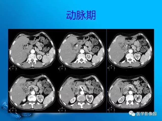 【病例】胆囊癌1例CT影像表现 【病例】胆囊癌1例CT影像表现