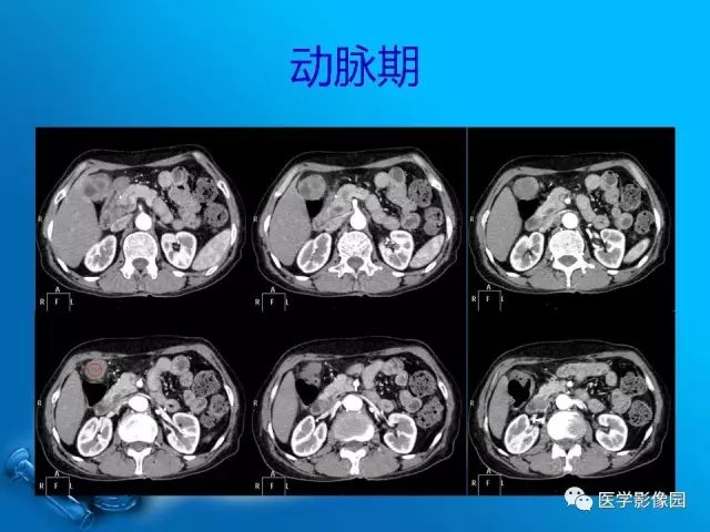 【病例】胆囊癌1例CT影像表现 【病例】胆囊癌1例CT影像表现
