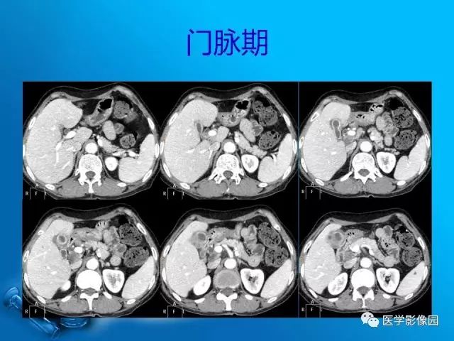 【病例】胆囊癌1例CT影像表现 【病例】胆囊癌1例CT影像表现